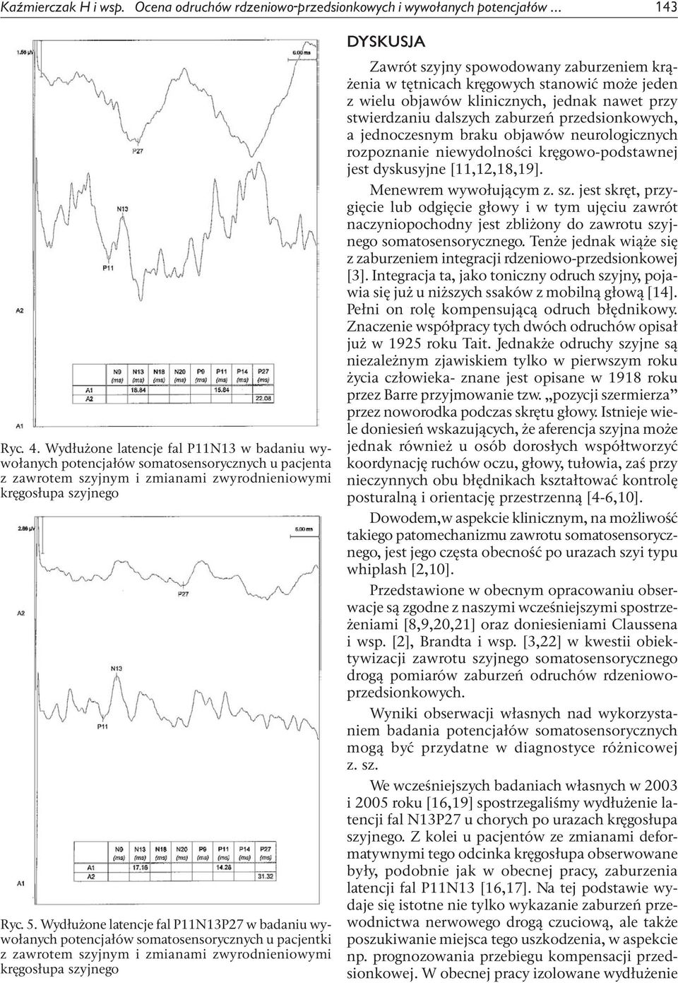 Wydłużone latencje fal P11N13P27 w badaniu wywołanych potencjałów somatosensorycznych u pacjentki z zawrotem szyjnym i zmianami zwyrodnieniowymi kręgosłupa szyjnego DYSKUSJA Zawrót szyjny spowodowany