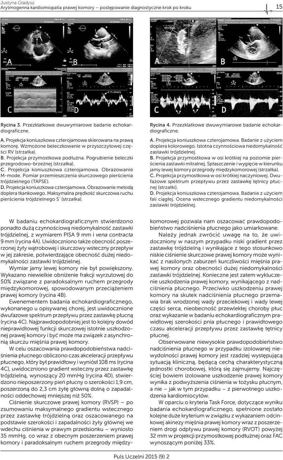 Obrazowanie M-mode. Pomiar przemieszczenia skurczowego pierścienia trójdzielnego (TAPSE). D. Projekcja koniuszkowa czterojamowa. Obrazowanie metodą doplera tkankowego.