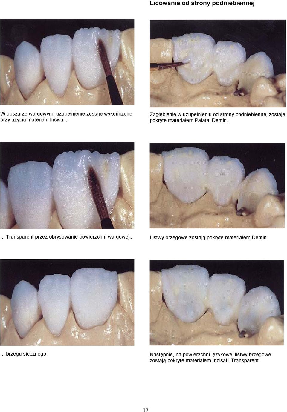 ... Transparent przez obrysowanie powierzchni wargowej... Listwy brzegowe zostają pokryte materiałem Dentin.