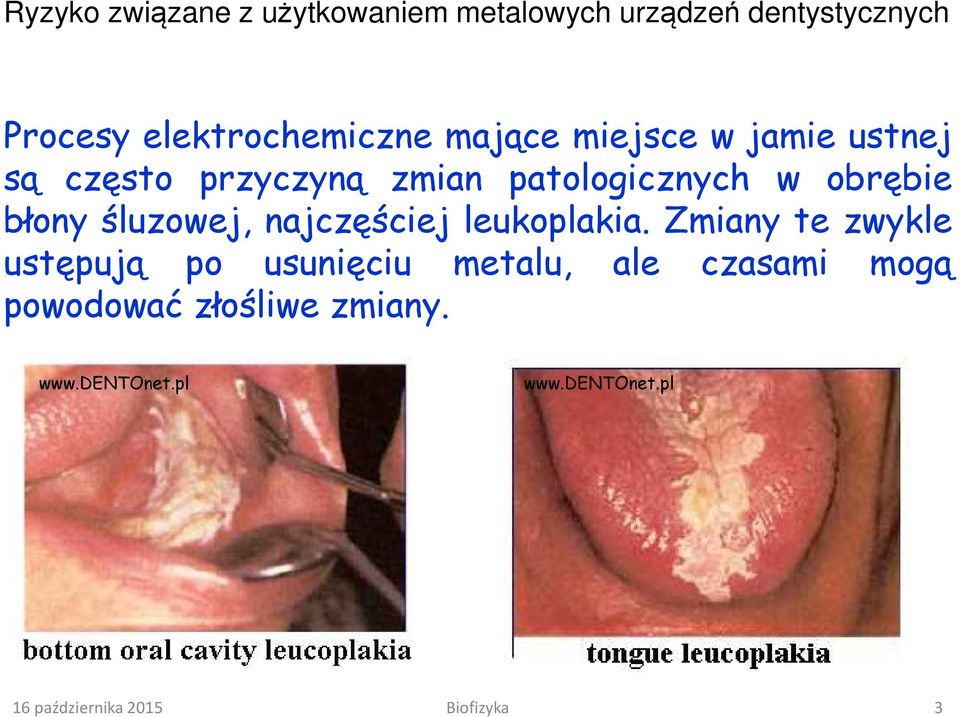 śluzowej, najczęściej leukoplakia.