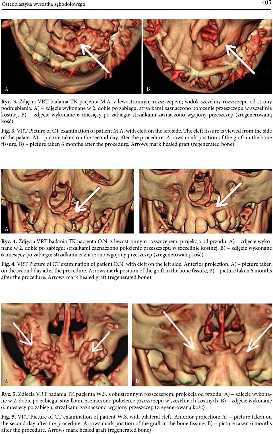 VRT Picture of CT examination of patient M.A. with cleft on the left side. The cleft fissure is viewed from the side of the palate: A) picture taken on the second day after the procedure.