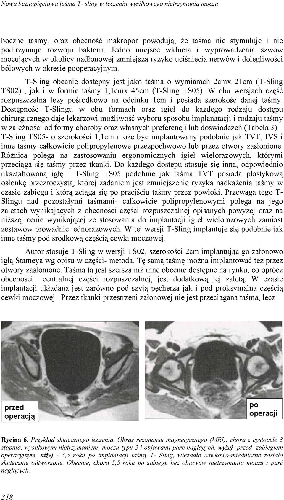 T-Sling obecnie dostępny jest jako taśma o wymiarach 2cmx 21cm (T-Sling TS02), jak i w formie taśmy 1,1cmx 45cm (T-Sling TS05).