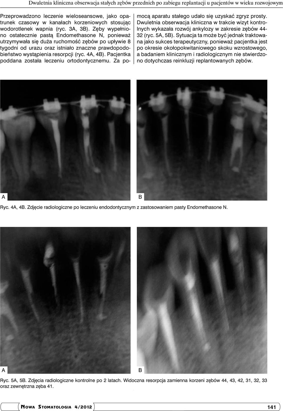 Zęby wypełniono ostatecznie pastą Endomethasone N, ponieważ utrzymywała się duża ruchomość zębów po upływie 8 tygodni od urazu oraz istniało znaczne prawdopodobieństwo wystąpienia resorpcji (ryc.