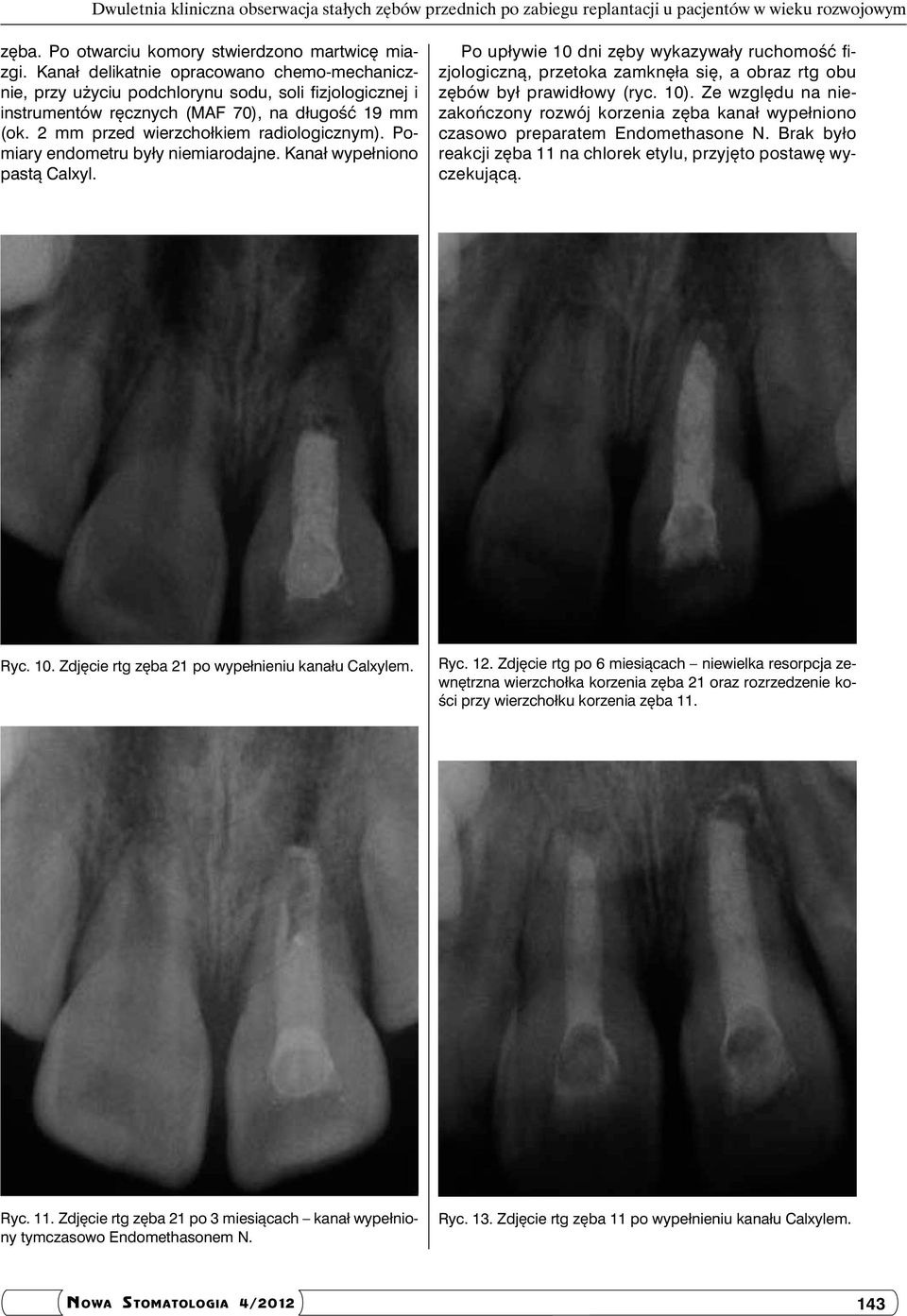 Pomiary endometru były niemiarodajne. Kanał wypełniono pastą Calxyl. Po upływie 10 dni zęby wykazywały ruchomość fizjologiczną, przetoka zamknęła się, a obraz rtg obu zębów był prawidłowy (ryc. 10).
