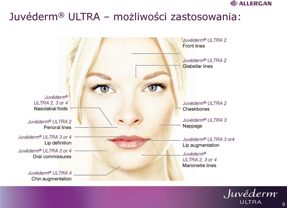 definition Juvéderm ULTRA 3 or 4 Oral commissures Juvéderm ULTRA 4 Chin augmentation Juvéderm ULTRA 2