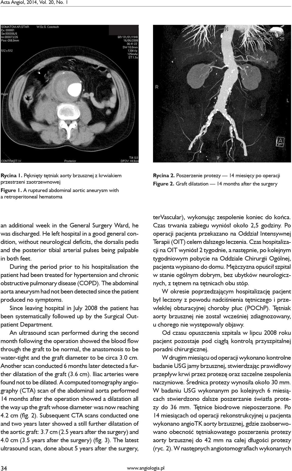 Graft dilatation 14 months after the surgery an additional week in the General Surgery Ward, he was discharged.