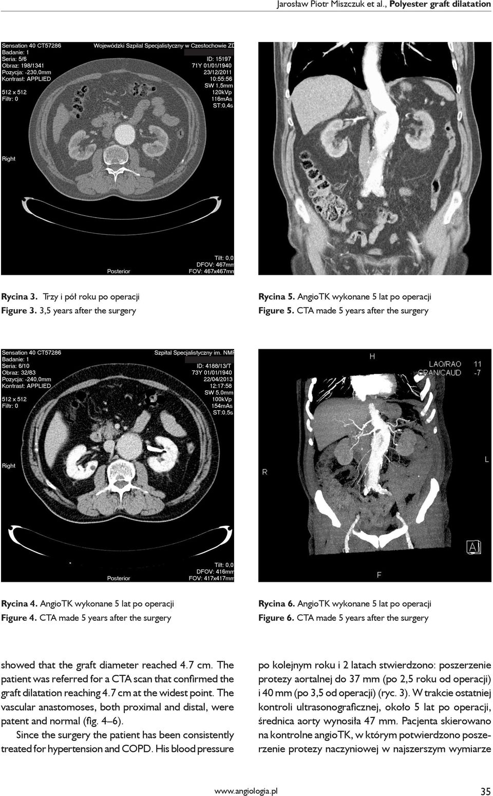 CTA made 5 years after the surgery showed that the graft diameter reached 4.7 cm. The patient was referred for a CTA scan that confirmed the graft dilatation reaching 4.7 cm at the widest point.