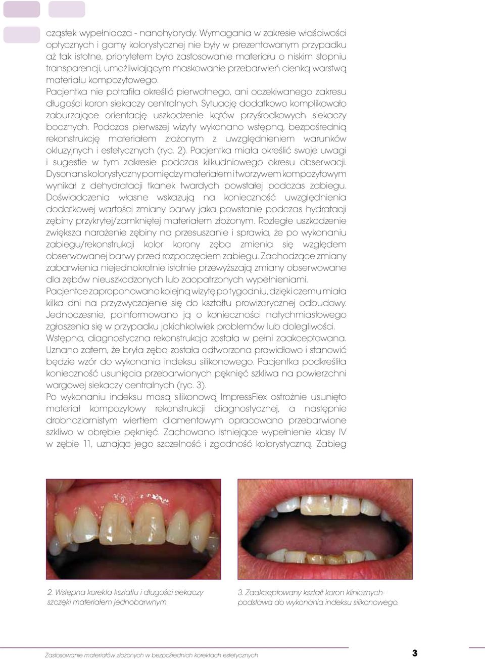 umożliwiającym maskowanie przebarwień cienką warstwą materiału kompozytowego. Pacjentka nie potrafiła określić pierwotnego, ani oczekiwanego zakresu długości koron siekaczy centralnych.