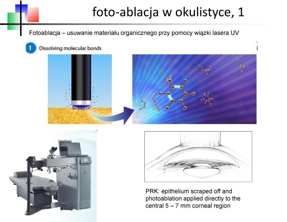 UV PRK: epithelium scraped off and photoablation