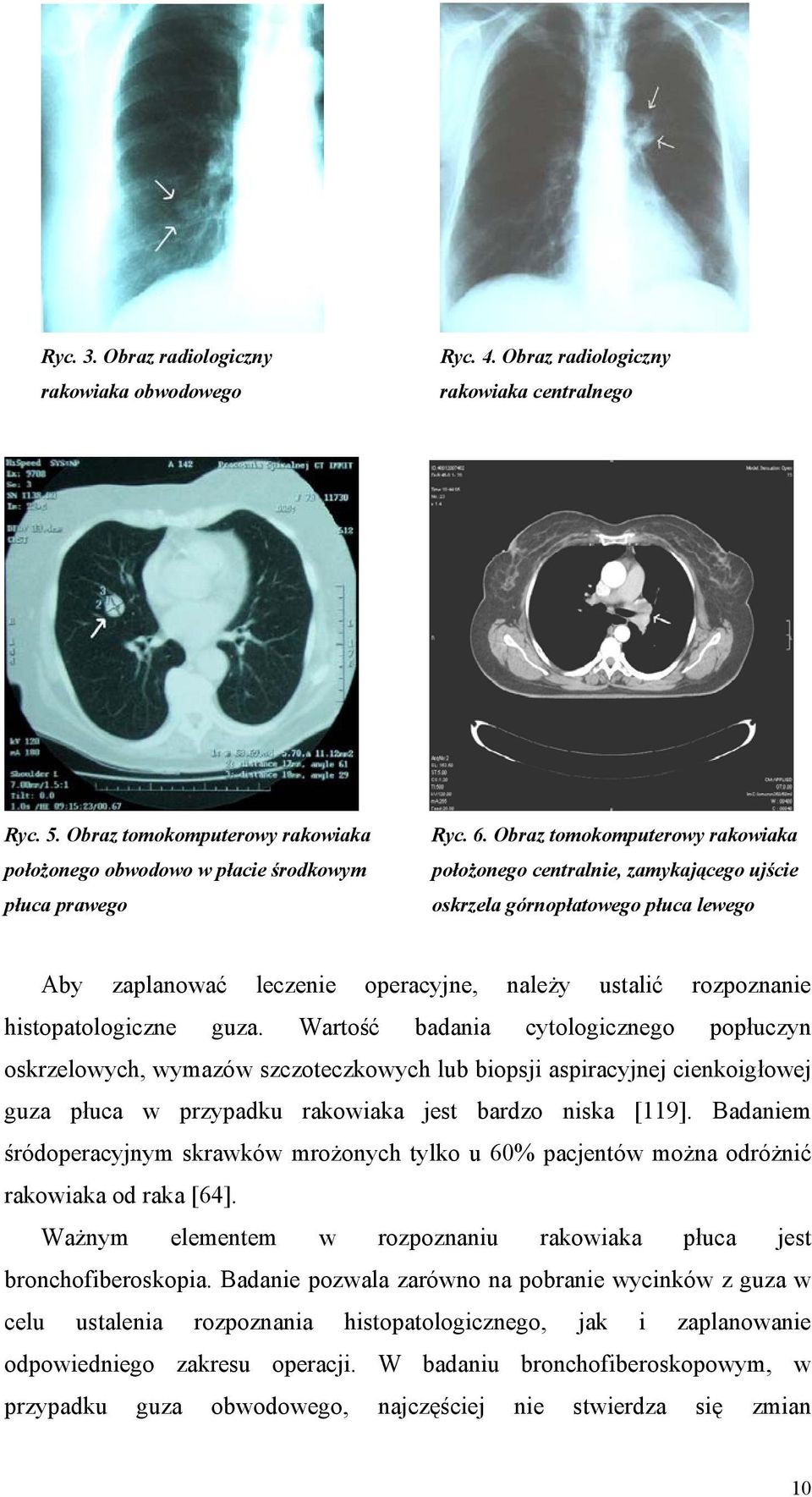 Wartość badania cytologicznego popłuczyn oskrzelowych, wymazów szczoteczkowych lub biopsji aspiracyjnej cienkoigłowej guza płuca w przypadku rakowiaka jest bardzo niska [119].