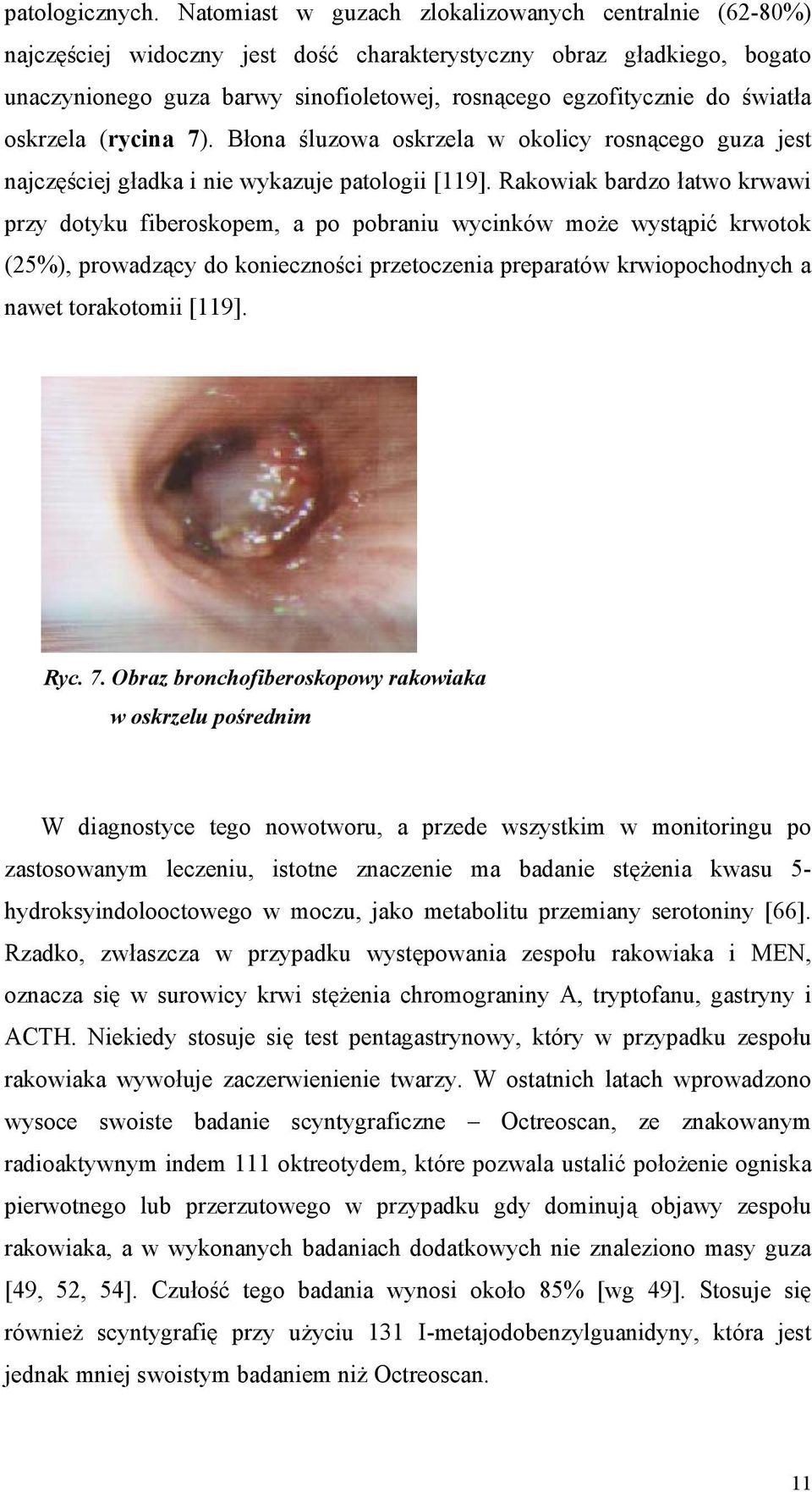 światła oskrzela (rycina 7). Błona śluzowa oskrzela w okolicy rosnącego guza jest najczęściej gładka i nie wykazuje patologii [119].