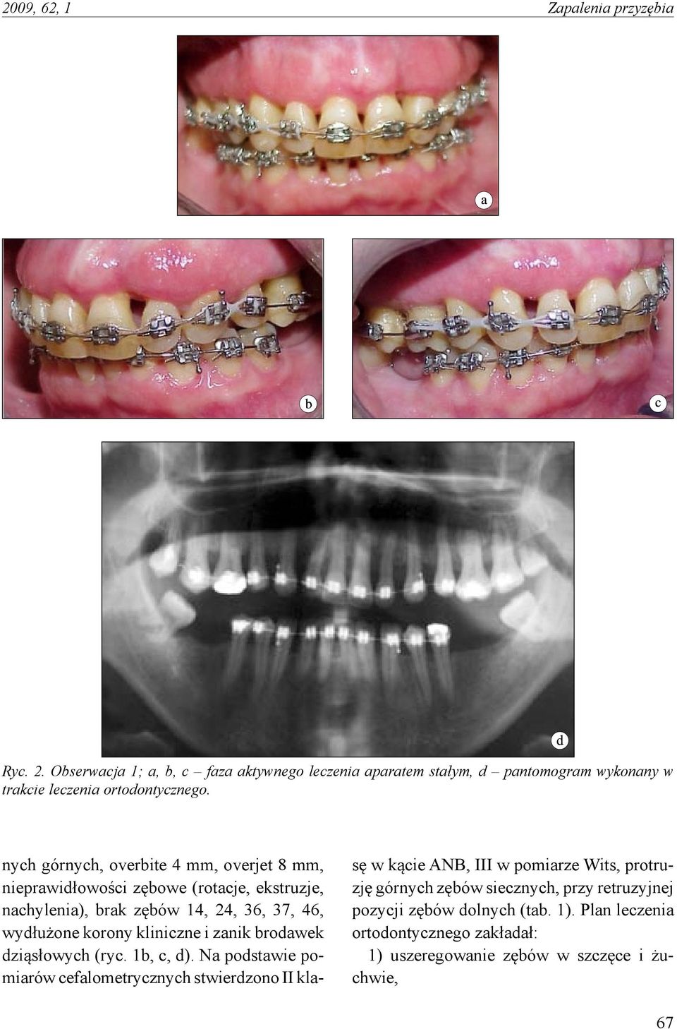 nych górnych, overbite 4 mm, overjet 8 mm, nieprawidłowości zębowe (rotacje, ekstruzje, nachylenia), brak zębów 14, 24, 36, 37, 46, wydłużone korony