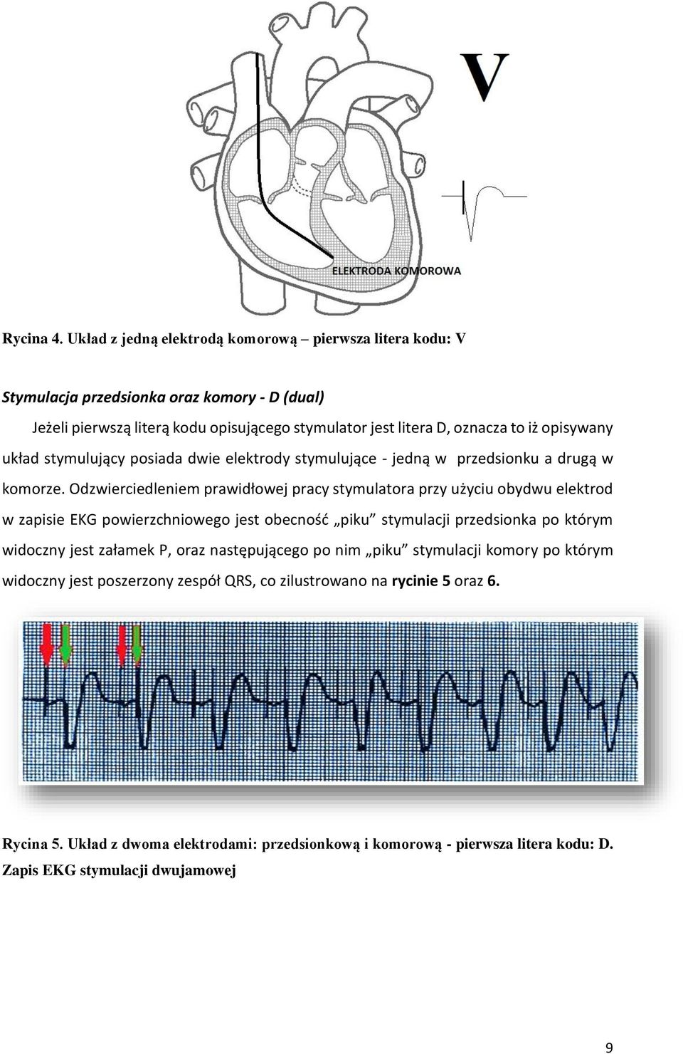 opisywany układ stymulujący posiada dwie elektrody stymulujące - jedną w przedsionku a drugą w komorze.