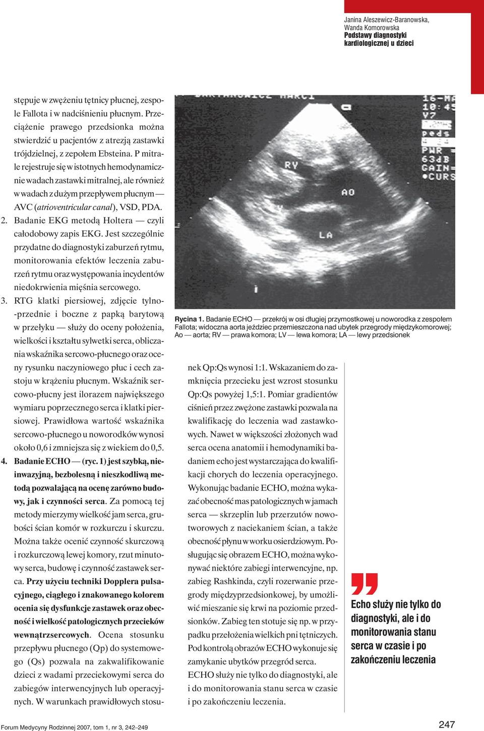 P mitrale rejestruje się w istotnych hemodynamicznie wadach zastawki mitralnej, ale również w wadach z dużym przepływem płucnym AVC (atrioventricular canal), VSD, PDA. 2.