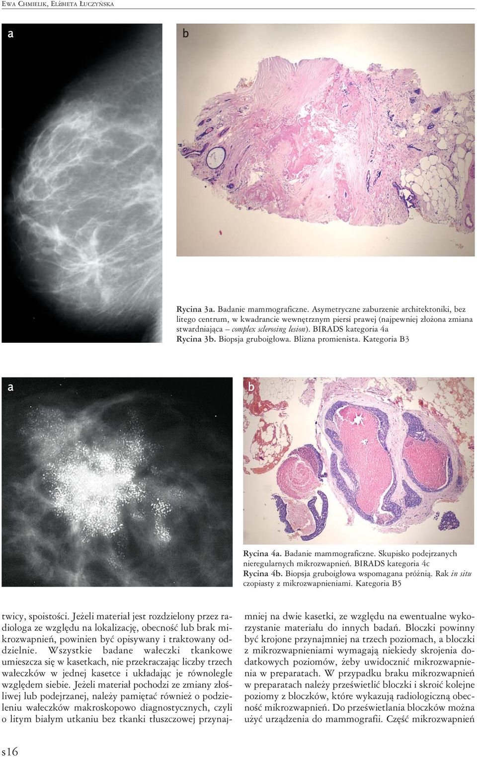 Blizn promienist. Ktegori B3 Rycin 4. Bdnie mmmogrficzne. Skupisko podejrznych nieregulrnych mikrozwpnień. BIRADS ktegori 4c Rycin 4. Biopsj gruoigłow wspomgn próżnią.