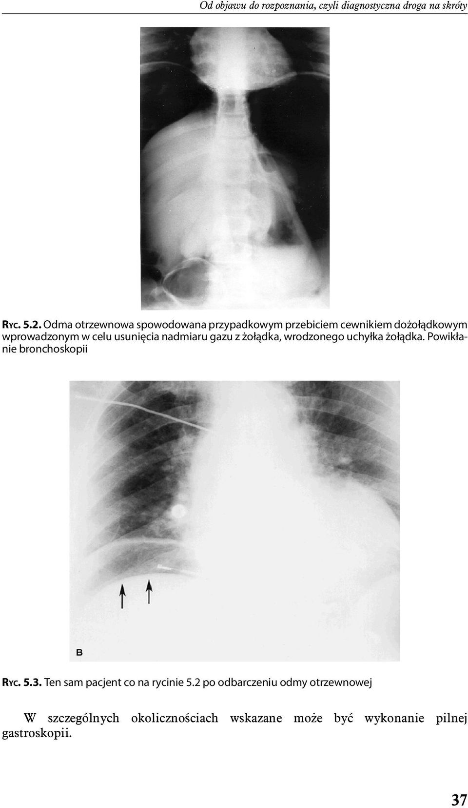 usunięcia nadmiaru gazu z żołądka, wrodzonego uchyłka żołądka. Powikłanie bronchoskopii RYC. 5.3.