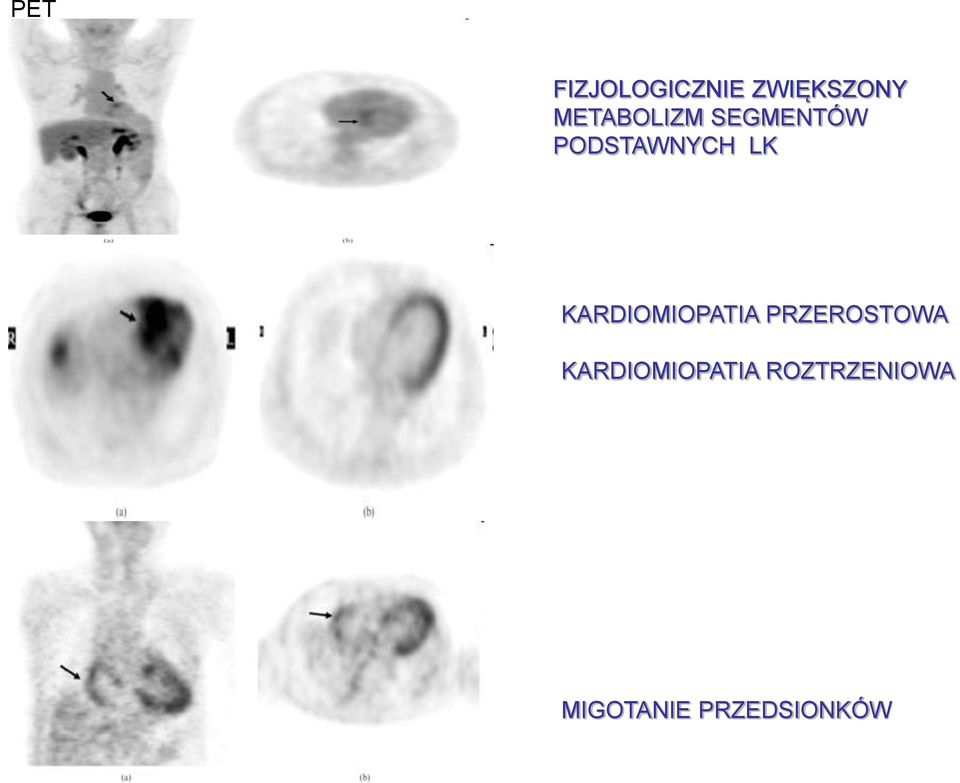 KARDIOMIOPATIA PRZEROSTOWA