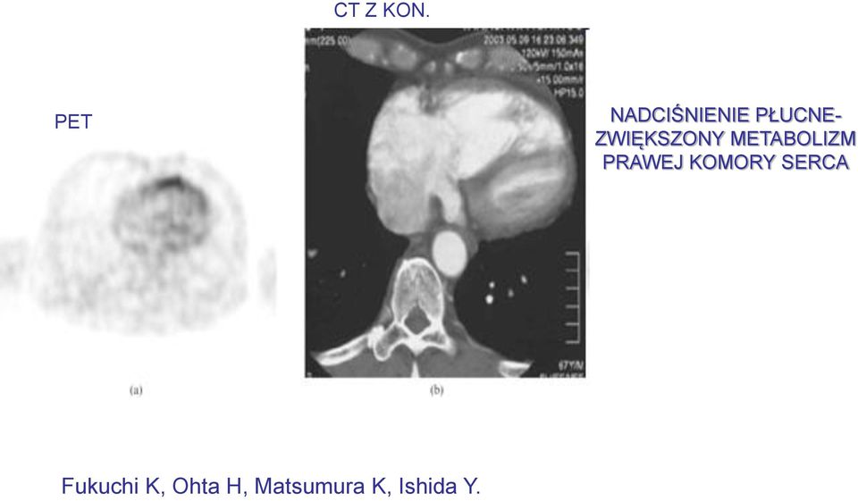 ZWIĘKSZONY METABOLIZM PRAWEJ