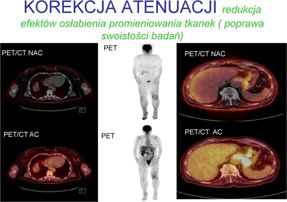 poprawa swoistości badań) PET/CT NAC