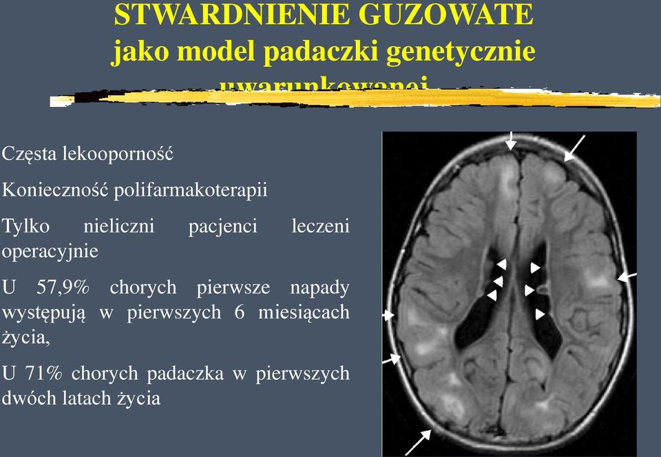 pacjenci leczeni operacyjnie U 57,9% chorych pierwsze napady występują w