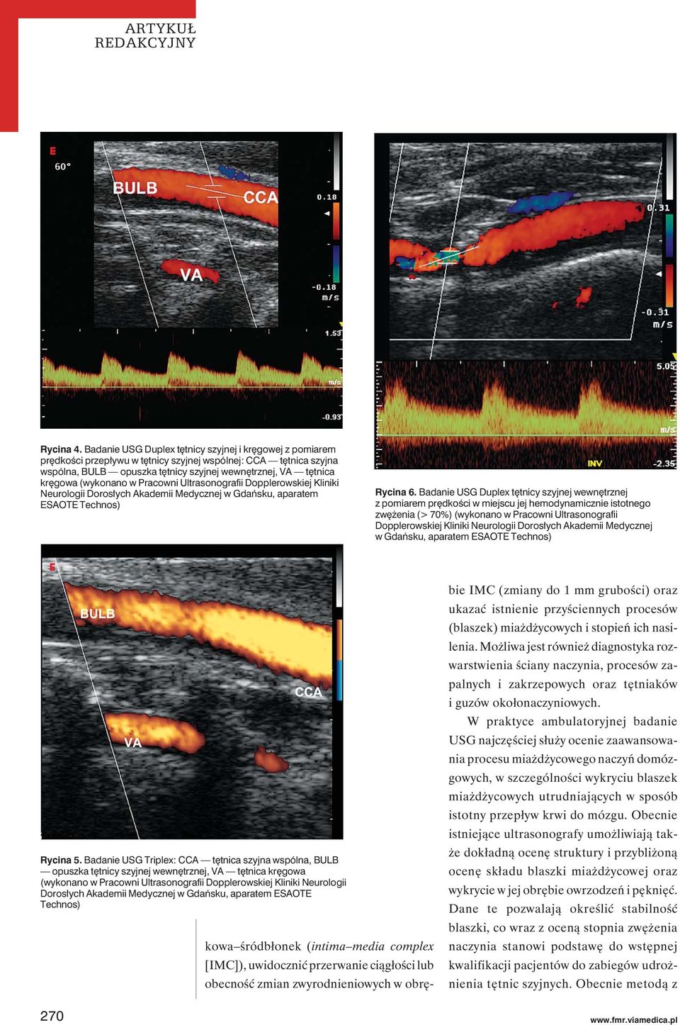 (wykonano w Pracowni Ultrasonografii Dopplerowskiej Kliniki Neurologii Dorosłych Akademii Medycznej w Gdańsku, aparatem ESAOTE Technos) Rycina 6.