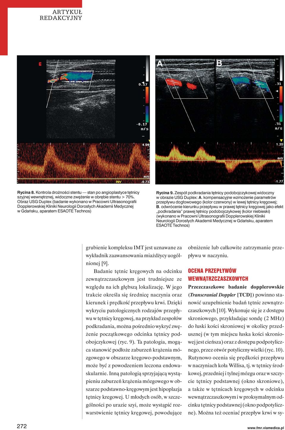 Zespół podkradania tętnicy podobojczykowej widoczny w obrazie USG Duplex: A. kompensacyjne wzmożenie parametrów przepływu dogłowowego (kolor czerwony) w lewej tętnicy kręgowej; B.