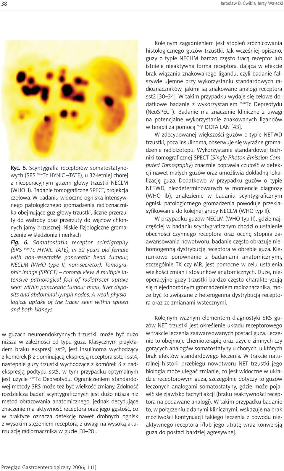 W badaniu widoczne ogniska intensywnego patologicznego gromadzenia radioznacznika obejmujące guz głowy trzustki, liczne przerzuty do wątroby oraz przerzuty do węzłów chłonnych jamy brzusznej.