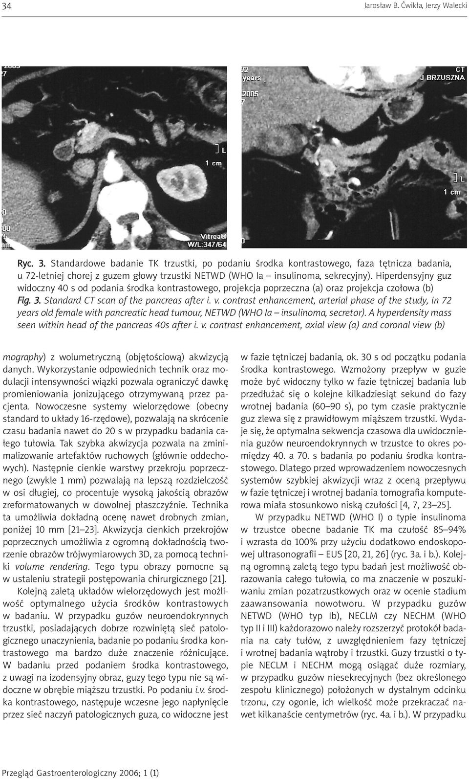 Hiperdensyjny guz widoczny 40 s od podania środka kontrastowego, projekcja poprzeczna (a) oraz projekcja czołowa (b) Fig. 3. Standard CT scan of the pancreas after i. v.