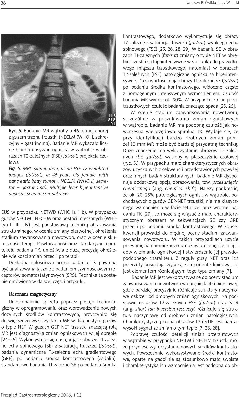 MRI examination, using FSE T2 weighted images (fat/sat), in 46 years old female, with pancreatic body tumour, NECLM (WHO II, secretor gastrinoma).