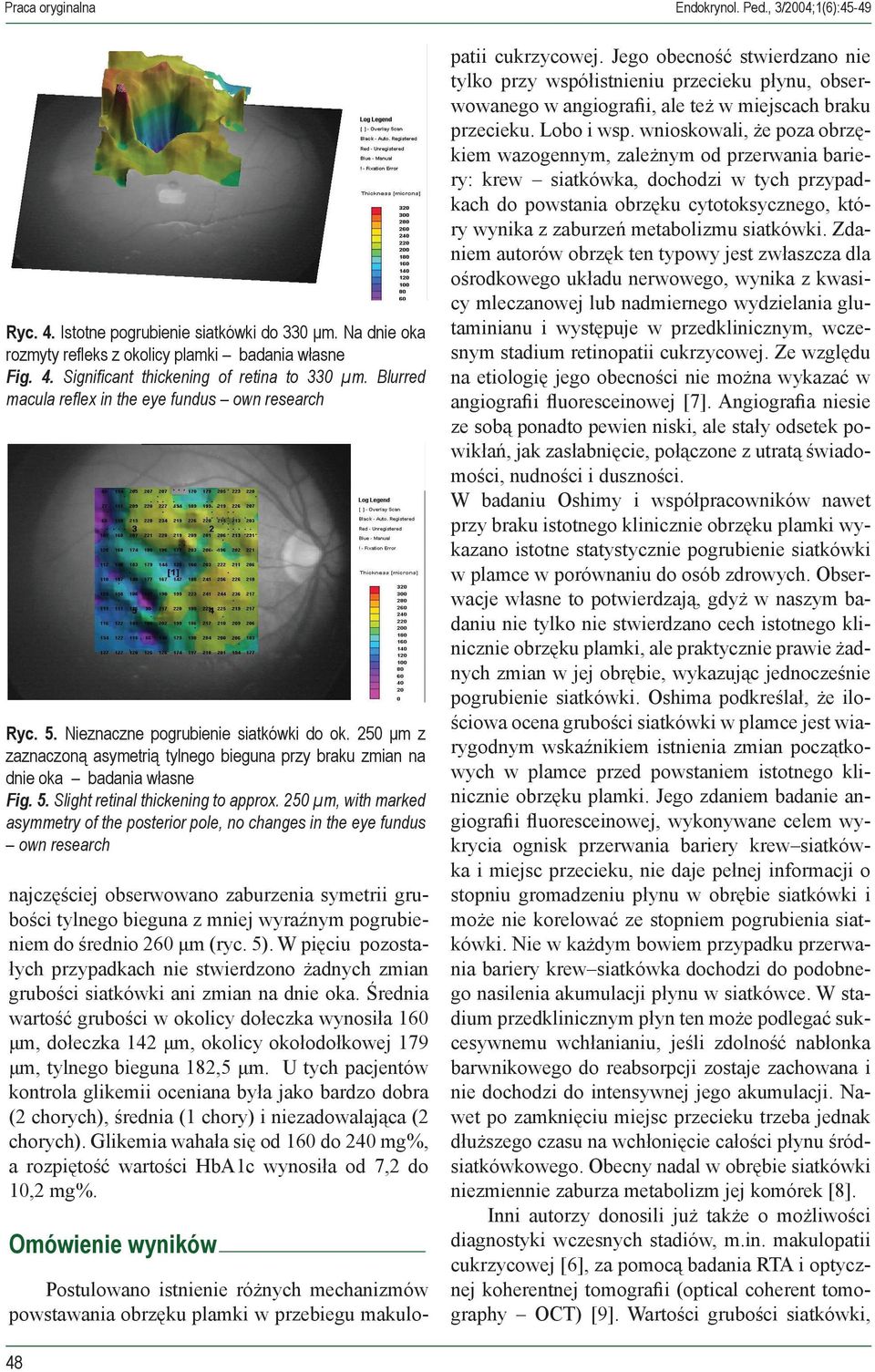 250 μm, with marked asymmetry of the posterior pole, no changes in the eye fundus own research najczęściej obserwowano zaburzenia symetrii grubości tylnego bieguna z mniej wyraźnym pogrubieniem do