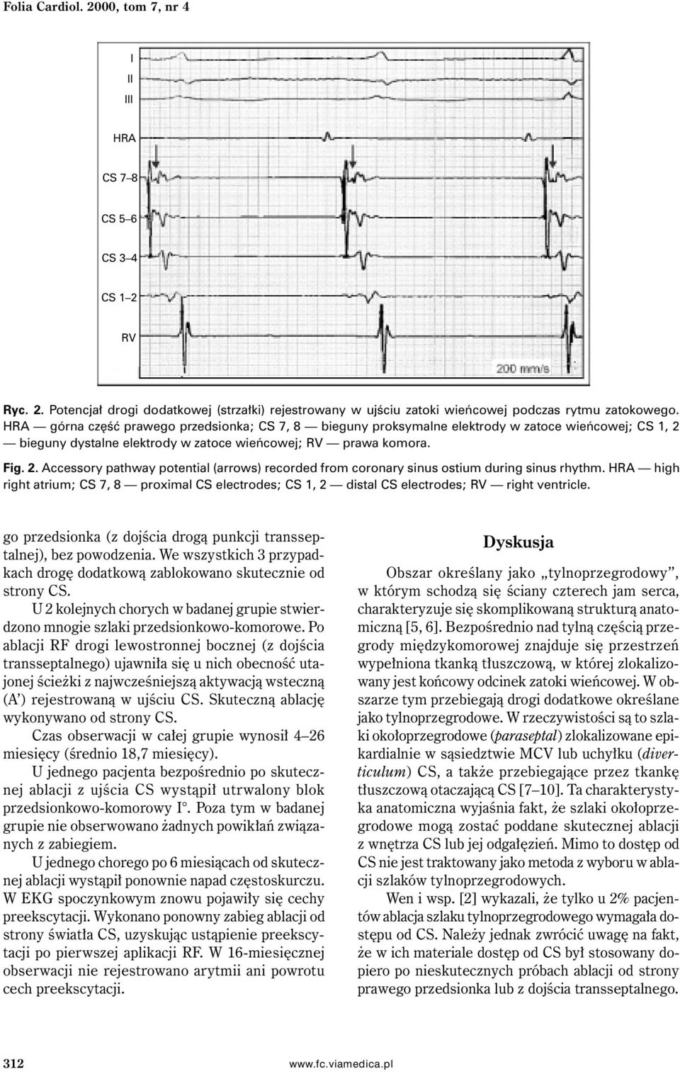 HRA high right atrium; CS 7, 8 proximal CS electrodes; CS 1, 2 distal CS electrodes; RV right ventricle. go przedsionka (z dojścia drogą punkcji transseptalnej), bez powodzenia.