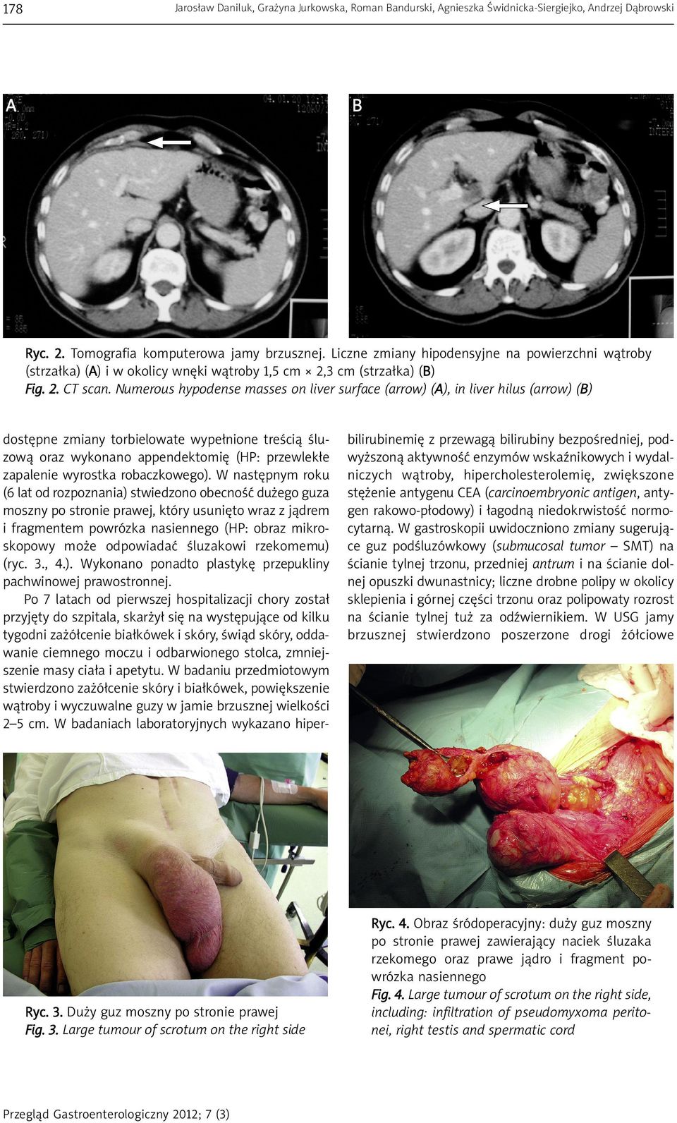 Numerous hypodense masses on liver surface (arrow) (A), in liver hilus (arrow) (B) dostępne zmiany torbielowate wypełnione treścią śluzową oraz wykonano appendektomię (HP: przewlekłe zapalenie