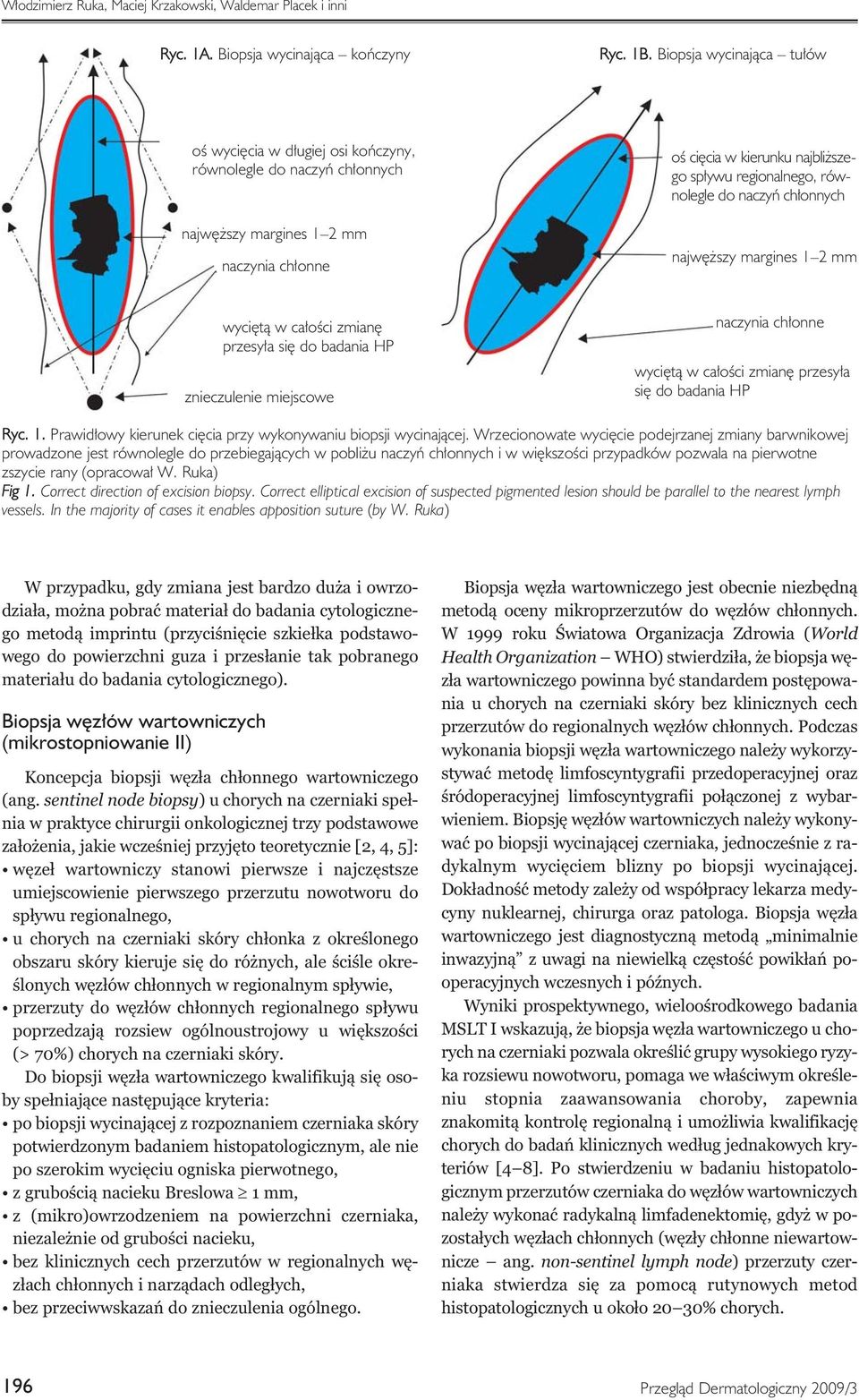 równolegle do naczyń chłonnych najwęższy margines 1 2 mm wyciętą w całości zmianę przesyła się do badania HP znieczulenie miejscowe naczynia chłonne wyciętą w całości zmianę przesyła się do badania