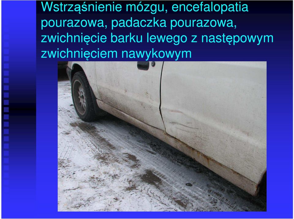 padaczka pourazowa, zwichnięcie