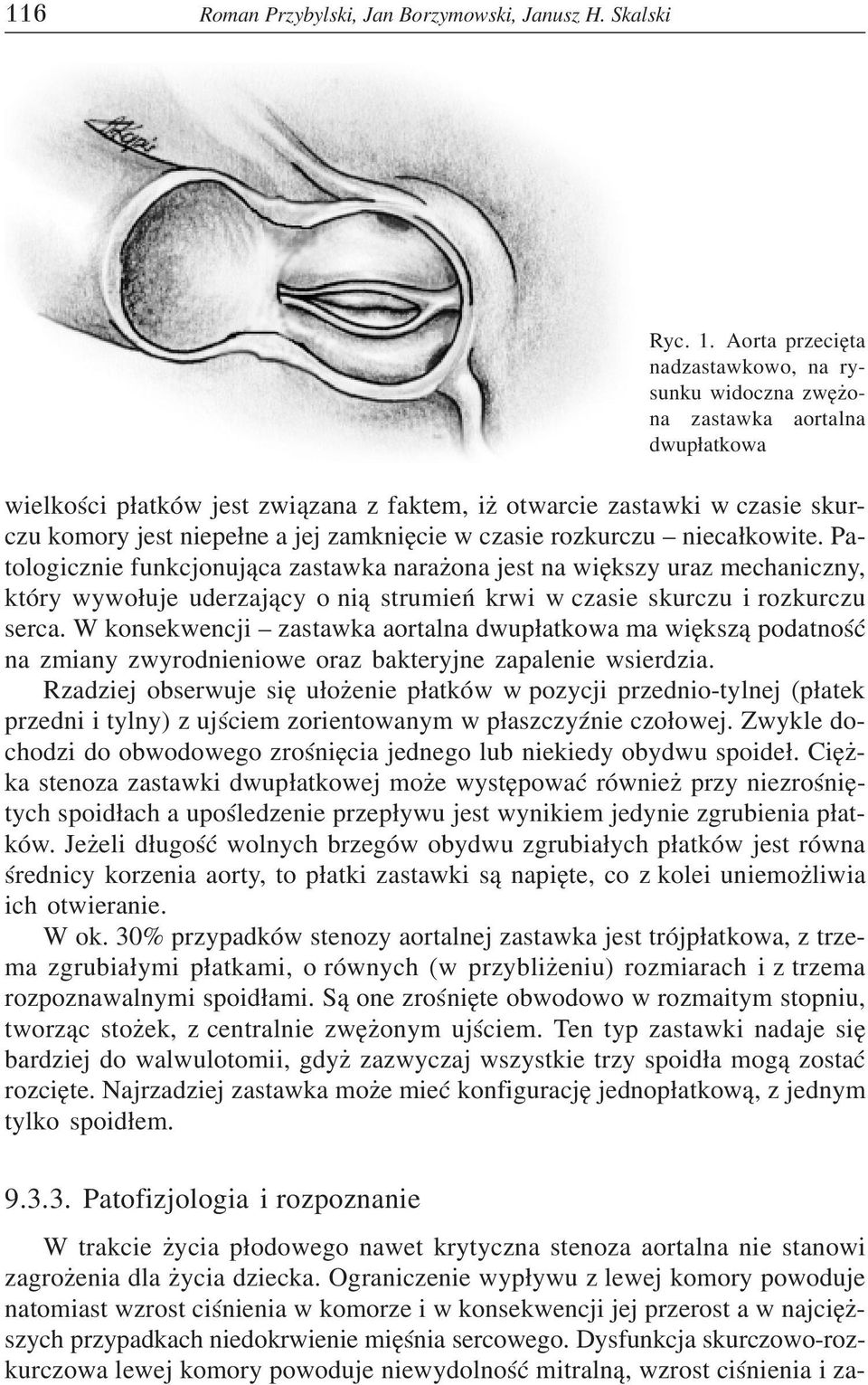 zamkniêcie w czasie rozkurczu nieca³kowite.