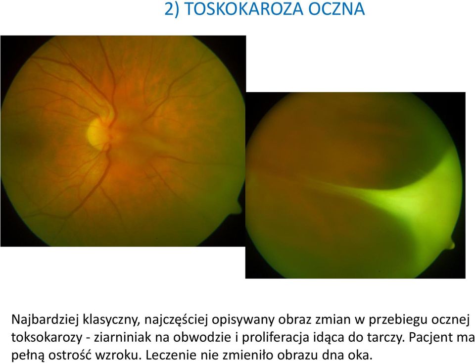 ziarniniak na obwodzie i proliferacja idąca do tarczy.