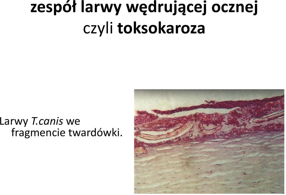 czyli toksokaroza