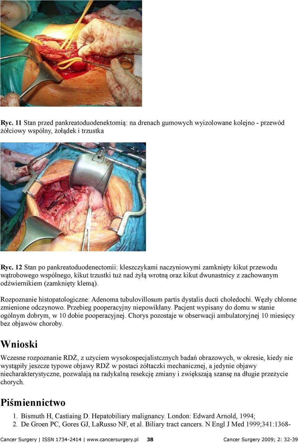 (zamknięty klemą). Rozpoznanie histopatologiczne: Adenoma tubulovillosum partis dystalis ducti choledochi. Węzły chłonne zmienione odczynowo. Przebieg pooperacyjny niepowikłany.