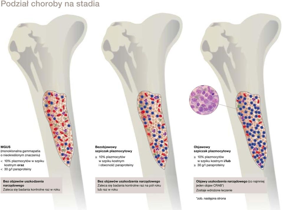 kostnym i/lub 30 g/l paraproteiny Bez objawów uszkodzenia narządowego Zaleca się badania kontrolne raz w roku Bez objawów uszkodzenia narządowego
