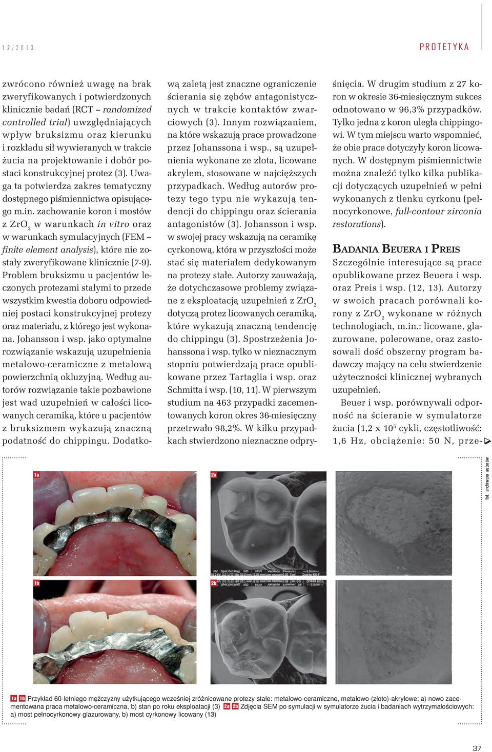 zachowanie koron i mostów z ZrO 2 w warunkach in vitro oraz w warunkach symulacyjnych (FEM finite element analysis), które nie zostały zweryfikowane klinicznie (7-9).