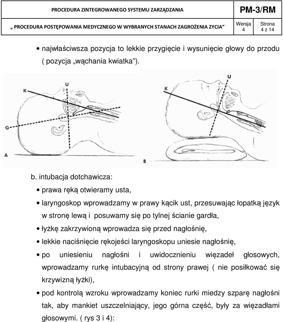 łyżkę zakrzywioną wprowadza się przed nagłośnię, lekkie naciśnięcie rękojeści laryngoskopu uniesie nagłośnię, po uniesieniu nagłośni i uwidocznieniu więzadeł głosowych,