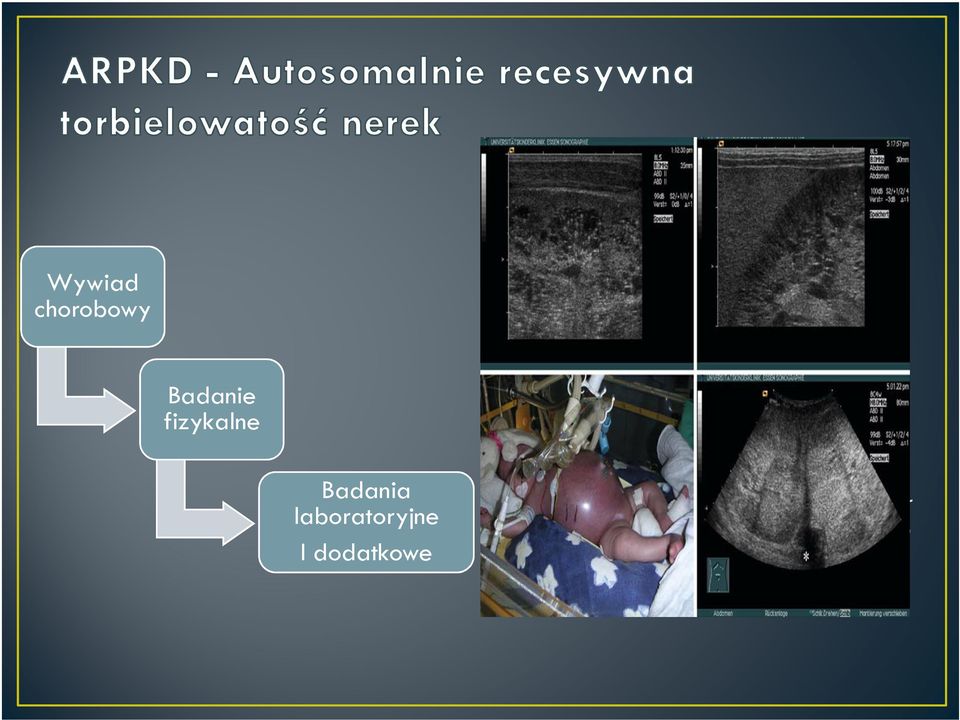 Zespół Williamsa Wrodzony przerost nadnerczy Z Allagille AD nadciśnienie z