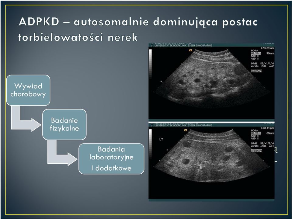 Zespół Williamsa Wrodzony przerost nadnerczy Z Allagille AD nadciśnienie z