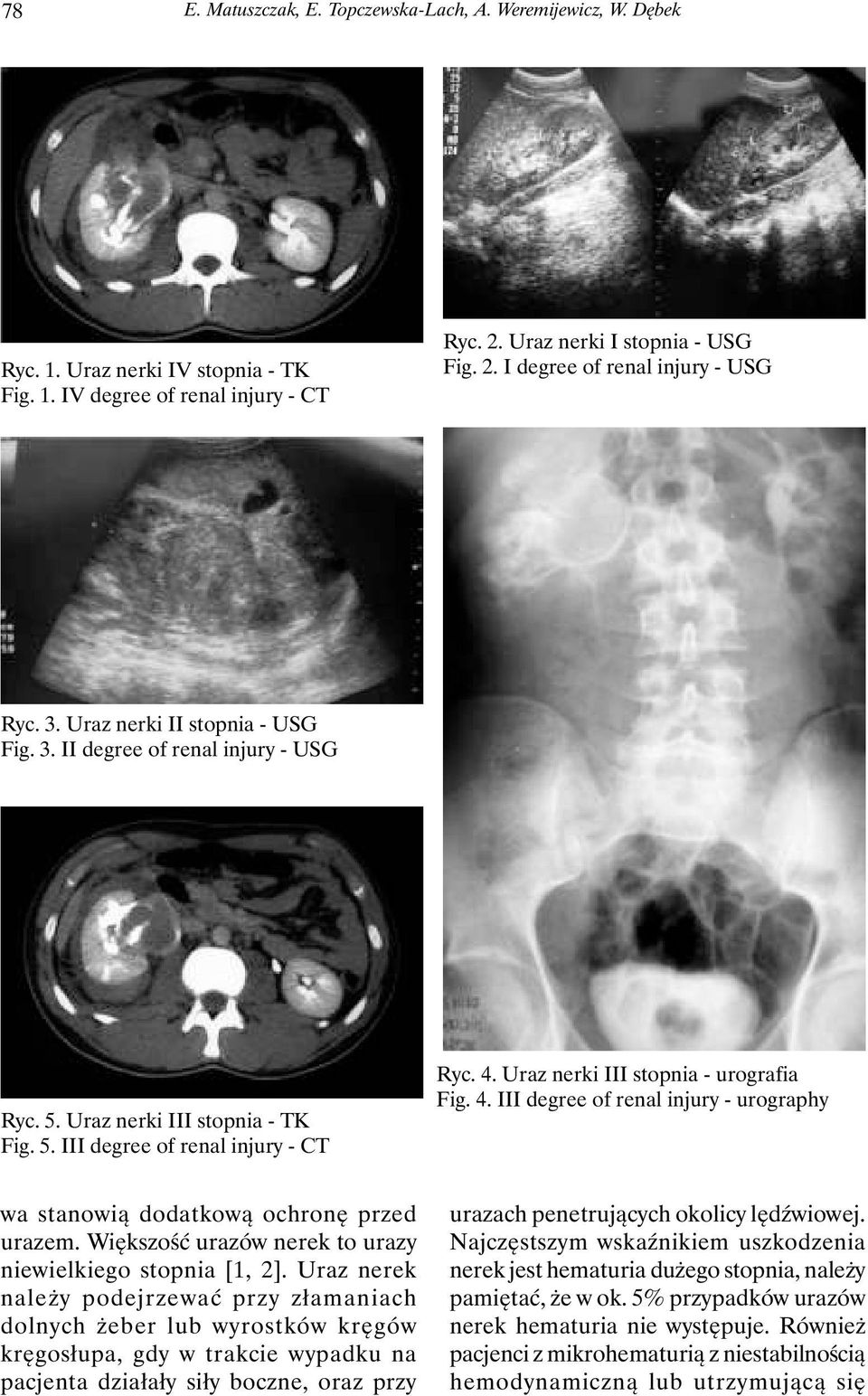 Uraz nerki III stopnia - urografia Fig. 4. III degree of renal injury - urography wa stanowią dodatkową ochronę przed urazem. Większość urazów nerek to urazy niewielkiego stopnia [1, 2].