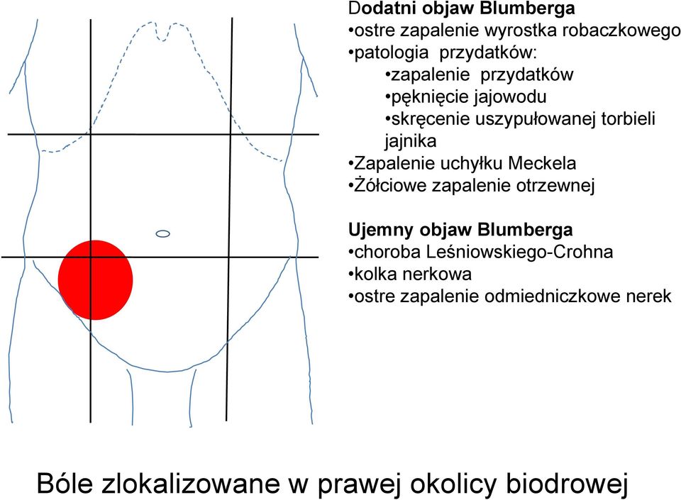 uchyłku Meckela śółciowe zapalenie otrzewnej Ujemny objaw Blumberga choroba