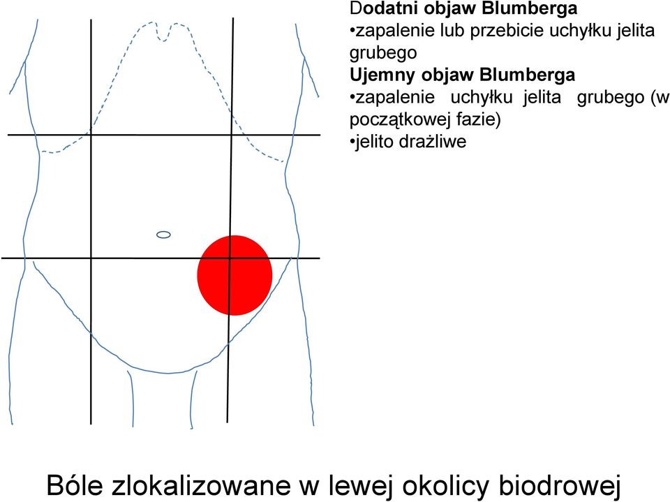 zapalenie uchyłku jelita grubego (w początkowej