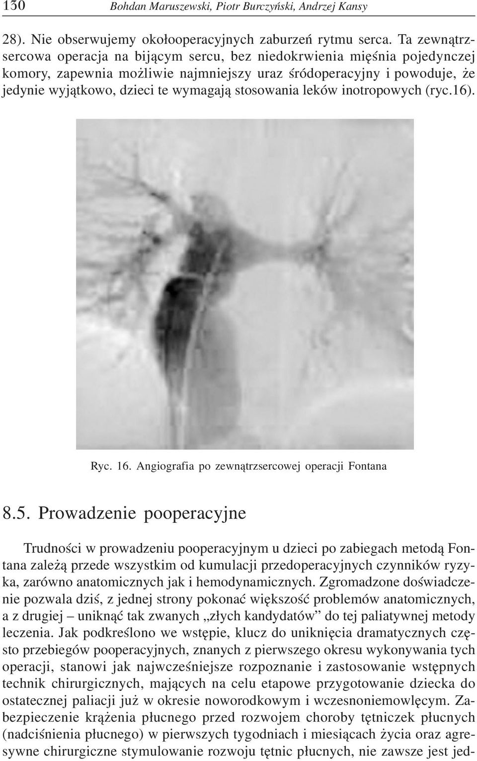 stosowania leków inotropowych (ryc.16). Ryc. 16. Angiografia po zewnątrzsercowej operacji Fontana 8.5.