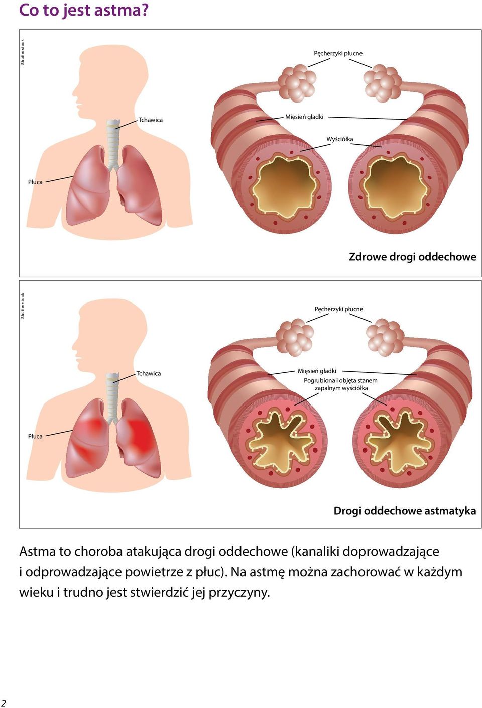 płucne Tchawica Mięsień gładki Pogrubiona i objęta stanem zapalnym wyściółka Płuca Drogi oddechowe astmatyka