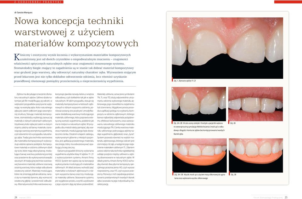 Stomatolodzy biegle znający te zagadnienia są w stanie tak dobrać materiał kompozytowy oraz grubość jego warstwy, aby odtworzyć naturalny charakter zęba.