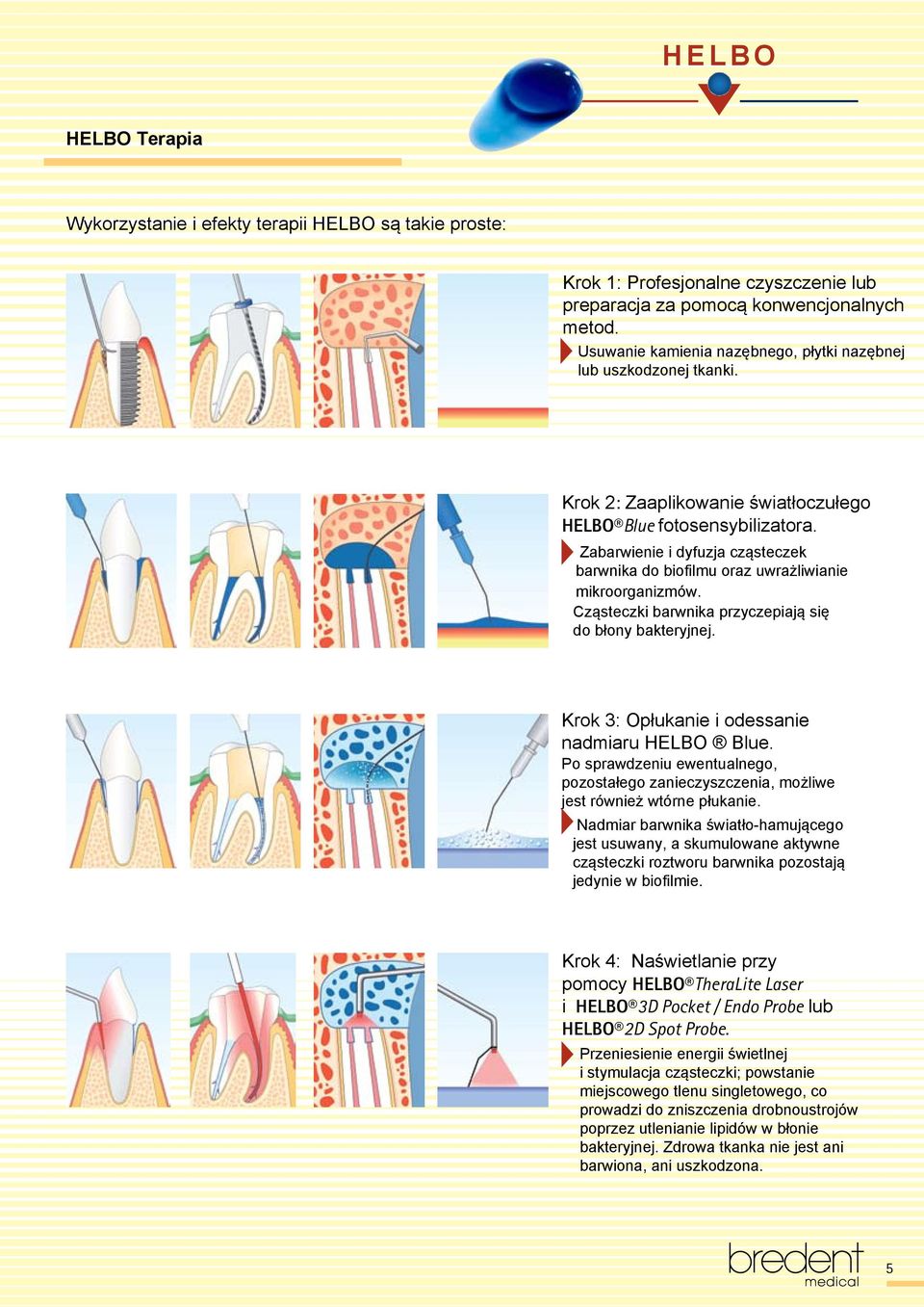 Zabarwienie i dyfuzja cząsteczek barwnika do biofilmu oraz uwrażliwianie mikroorganizmów. Cząsteczki barwnika przyczepiają się do błony bakteryjnej. Krok 3: Opłukanie i odessanie nadmiaru HELBO Blue.